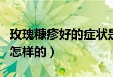 玫瑰糠疹好的症状是什么（玫瑰糠疹的症状是怎样的）