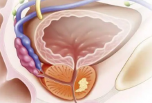 前列腺癌尿检确定预后良好的患者