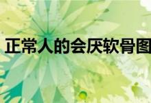 正常人的会厌软骨图（正常人的会厌部形态）