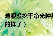 鸡眼没挖干净光肿是怎么回事（鸡眼挖干净后的样子）